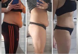 lipo lab before and after