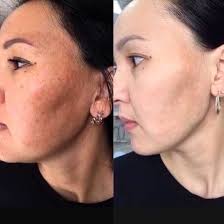 miracle touch br before and after