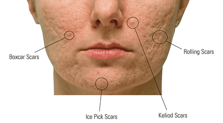 rejuran s acne scars types
