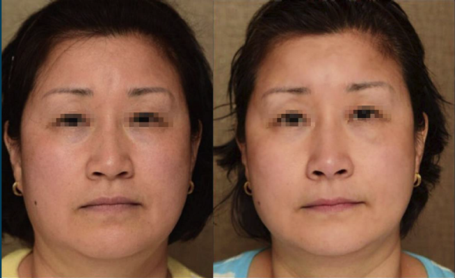 miracle touch up before and after